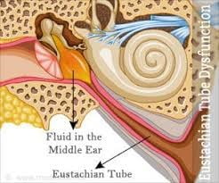 fluid in the ear