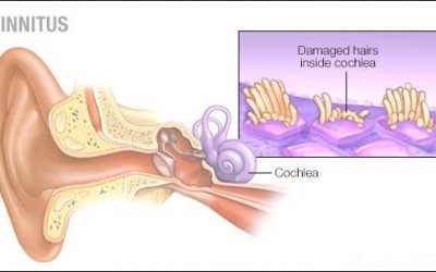 How Hearing Aids Can Help Manage Tinnitus