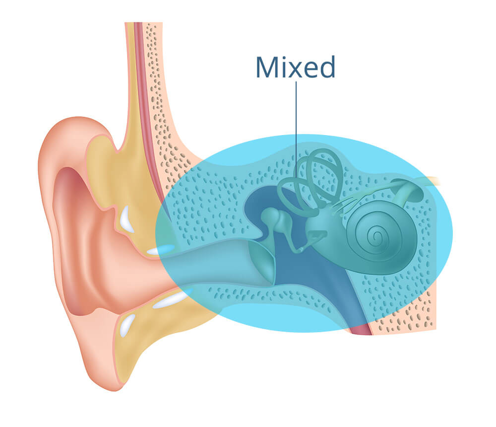 Mixed hearing loss